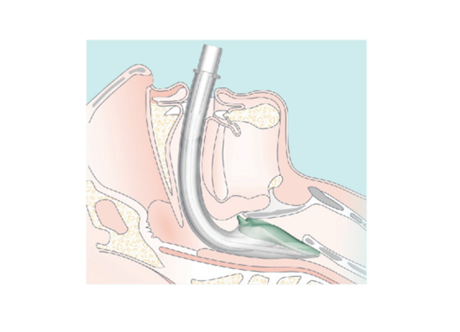 喉罩（英特赛克）